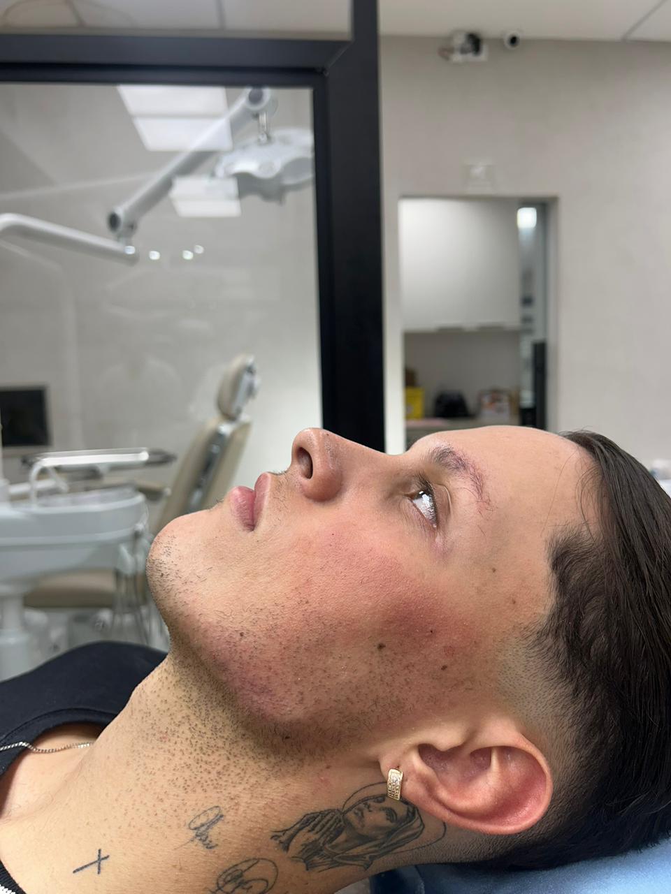 Resultado de harmonização masculina — definição facial natural